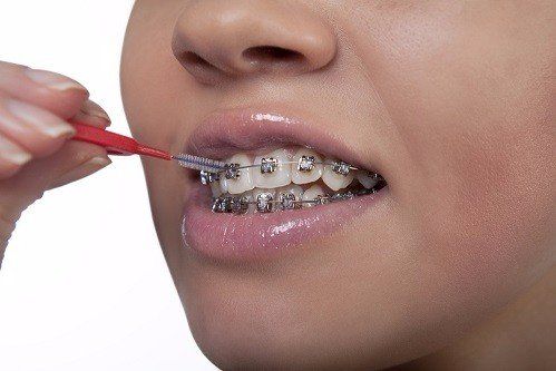 cleaning braces, how to clean braces, oral care